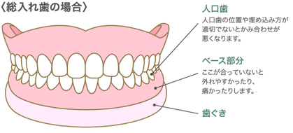 入れ歯の問題 合わない入れ歯を使い続けるとどうなる アールデンタルオフィス