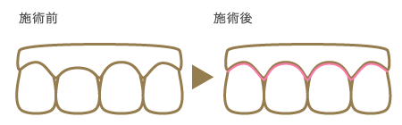 ガムラインを整える（1本） 施術前