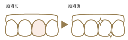 ウォーキングブリーチ（1本）